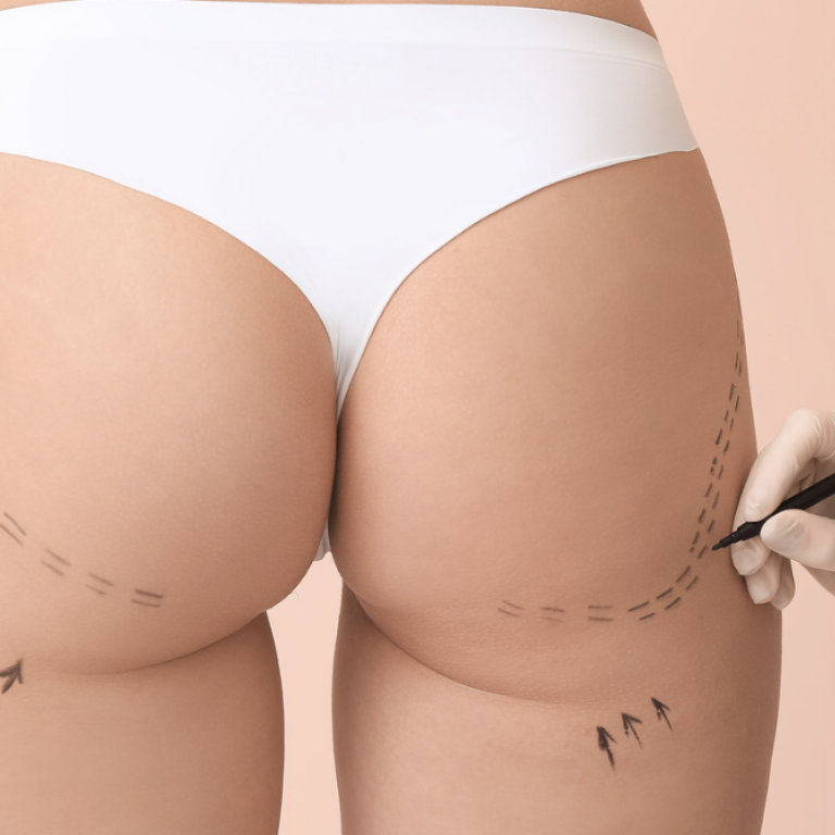 Non-Surgical Facelifts in Alexandria VA